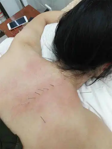 针灸治疗背痛