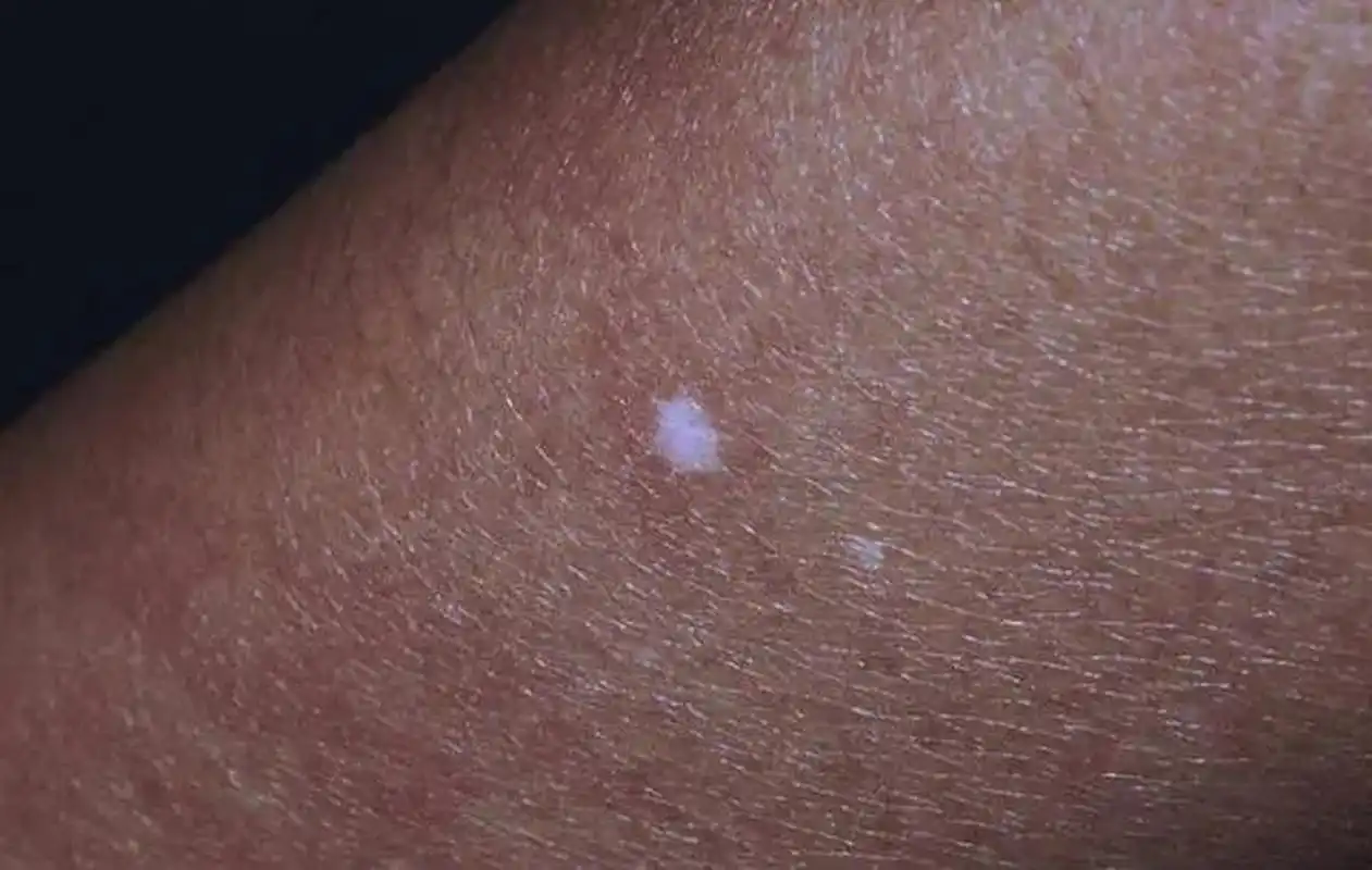 身上出现了一些小白点,有的人以为是白癜风