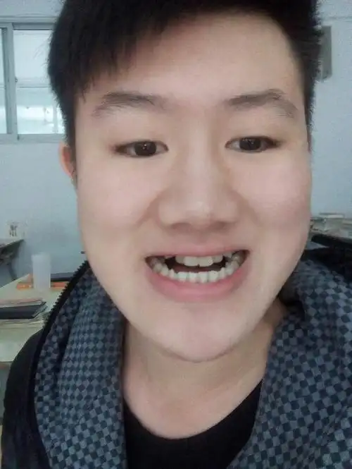 我是属于地包天的男生,因为地包天的我很自卑,请问下地包天在一般的镇