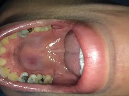 口腔硬颚肿块很怕