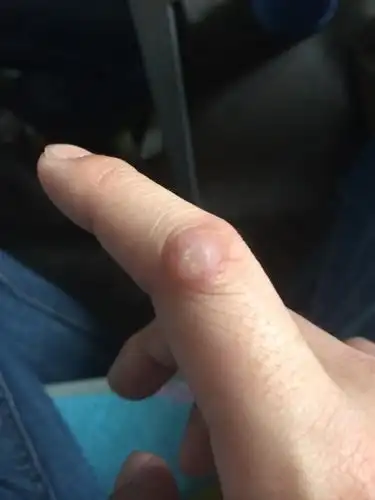 就是手指关节上长了不知道什么东西.那一片