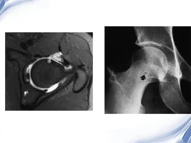 医学影像-股骨颈疝窝ppt
