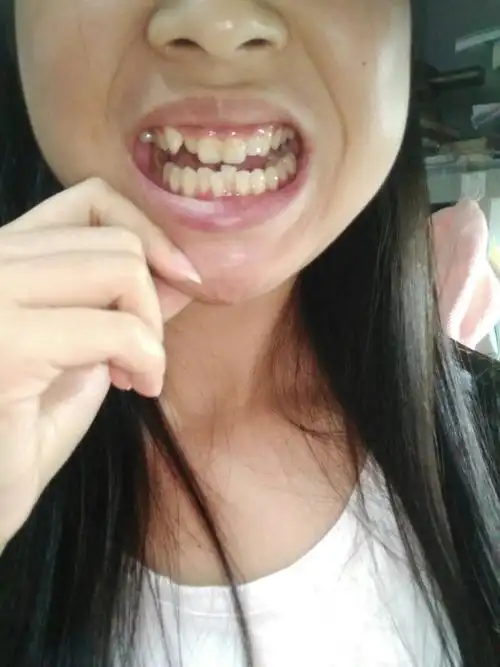 觉得自己的牙齿超级无敌丑,讲话和笑的时候也没有什么自信,加上笑起来