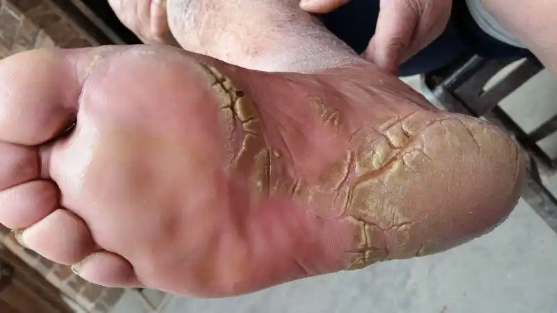 请问我爷爷的脚底严重开裂,是细菌感染还是生病啦!