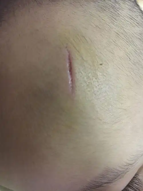 请专家来帮我看看,宝宝额头磕破了,有个坑,大约1.5cm.会留疤吗?