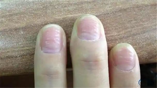 专家:可能预示5种健康风险[3p]   体内缺乏某种微量元素,会使手指甲的