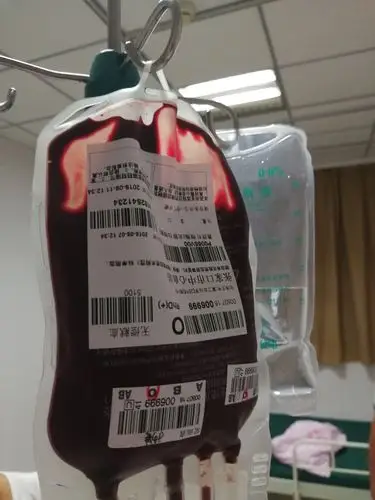 手术室手术仅用30分钟,术中清理大量积血约3000毫升,术中输血800毫升