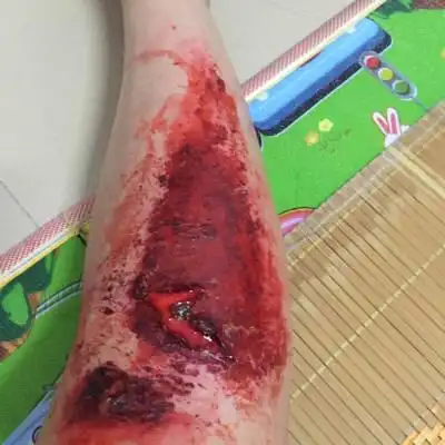 骑车摔伤了.脚上的伤一个星期了不见好转.