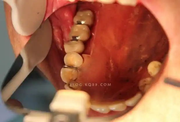 戴入口内,义齿稳定性很高对待不同的患者,不同的情况一定要活学活用