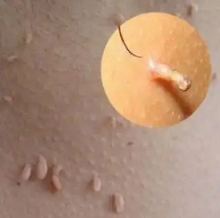 腋窝下为何容易长小肉粒?这些小肉粒是什么?对身体有影响吗?