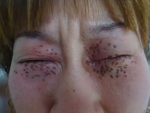 冷冻无效后电离子治疗粟丘疹第一次