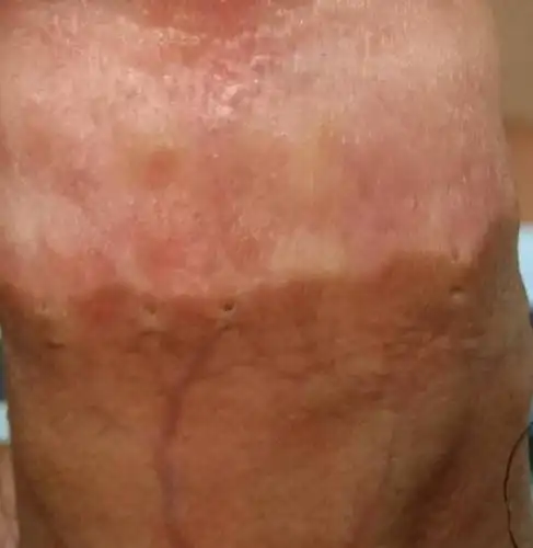 为什么做包皮手术两年了,颜色还是不一致,而且还有针眼,难看死了!