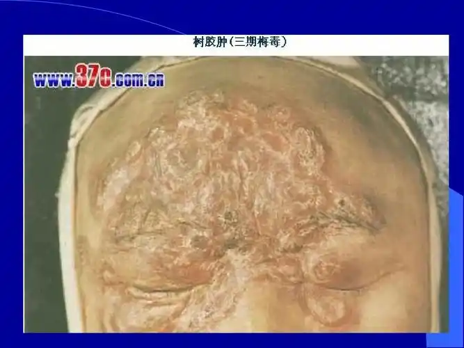 1全等三角形ppt课件 梅毒早期 梅毒治疗 先天性梅毒 的相关文档搜索