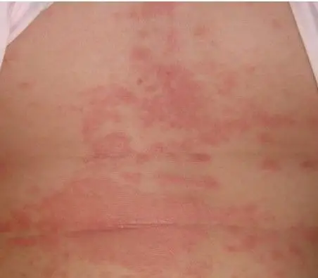 宝宝麻疹症状图片