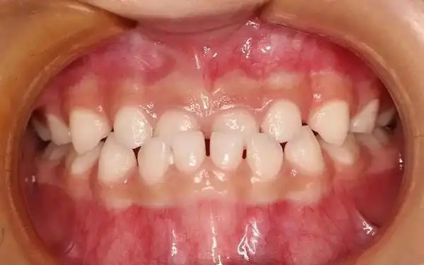 婴儿假性地包天