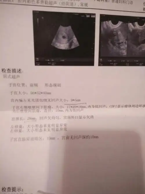 医生说应该可以看见孕囊了,可是为什么我没有孕囊只有光团呢?