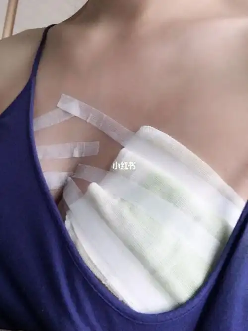 急性乳腺炎96堵奶96乳腺组织水肿96 拯救乳房大作战6015