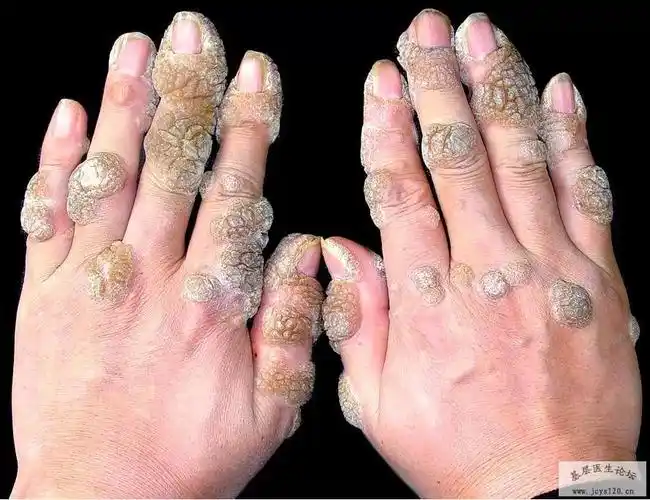 各种皮肤病的图片难得啊