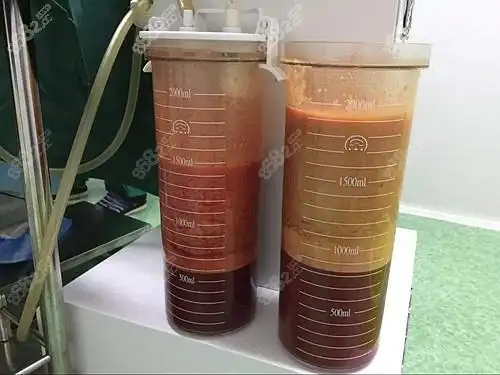 抽取出来的脂肪
