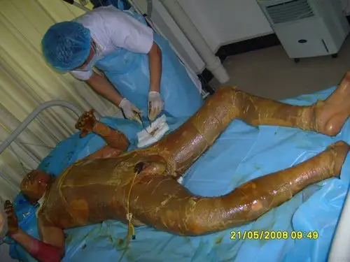 大面积烧伤治疗过程