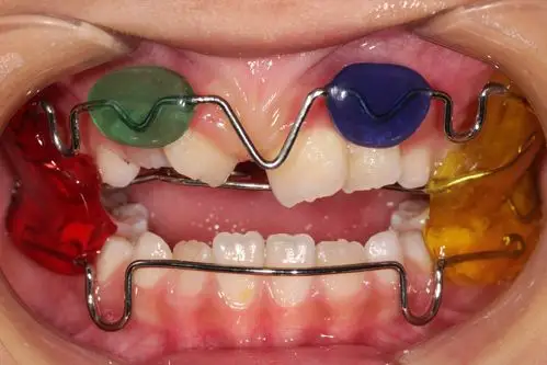 最勇敢的整牙小患者 3岁【地包天】