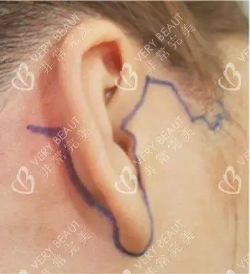 公开拉皮手术全过程看看能维持几年会有哪些的风险和后遗症