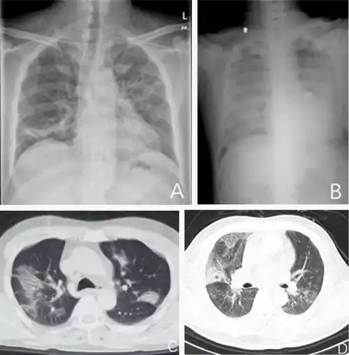 学会专家沪汉战"疫"系列(十七)普通型和重型新型冠状病毒肺炎康复患者