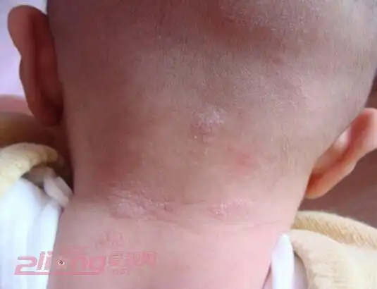 婴儿汗斑图片 婴儿汗斑治疗方法有哪些