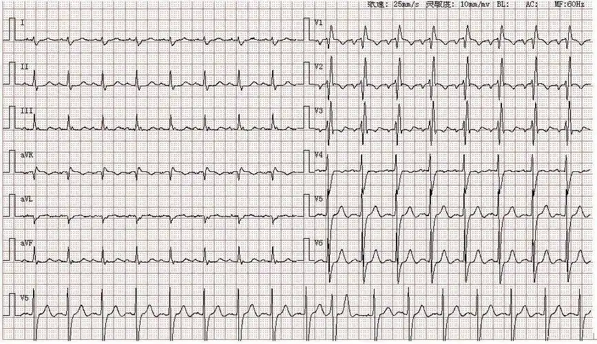 心电图图库丨二尖瓣型p波 - 知乎