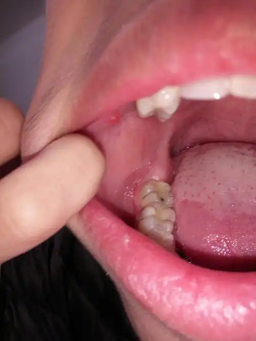 我在口腔右边长了一个痘痘是怎么回事不痛不痒不知道