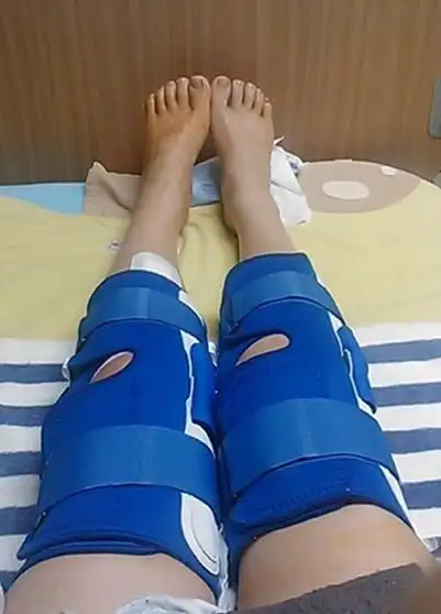 利用脂肪抽吸术矫正o形腿