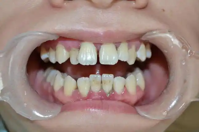 成年人牙齿稀疏怎么办?