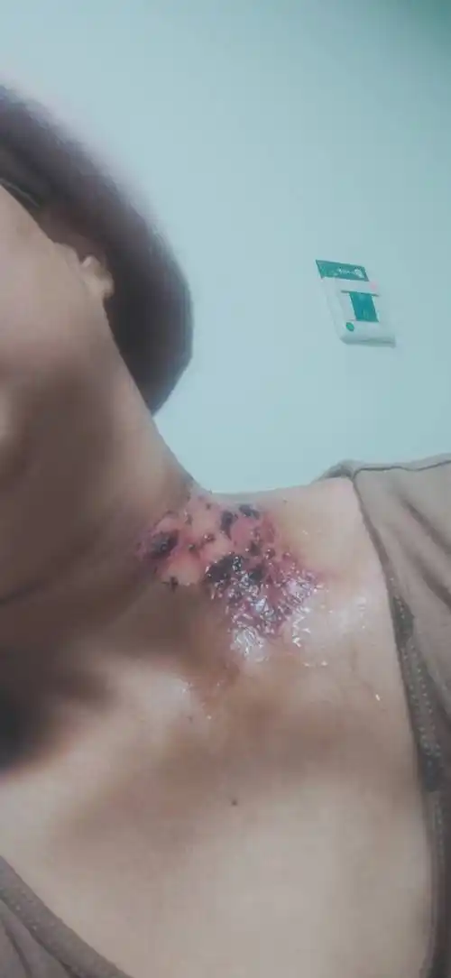 几天没来打卡了,放疗把皮肤放烂了,只能老实躲家里,锦燕12022-01-15