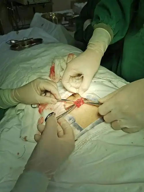 下精准治疗】川医泌尿外科成功开展显微镜下精索静脉结扎术_手术