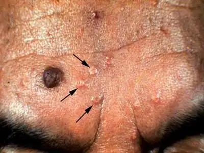 女性尖锐湿疣大多数无症状,症状为局部瘙痒,疼痛,性交后出血和阴道