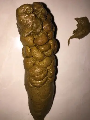 男孩28个月,便秘一年了,头有很长一段都很干,像羊粑粑,而且拉的也很粗