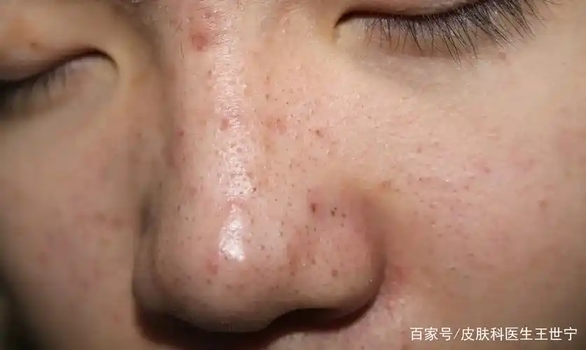 青春期脸上起黑头