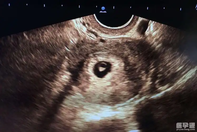 都是"尖男圆女",要生男孩的肚子特征是尖凸;生女孩的肚子特征是浑圆