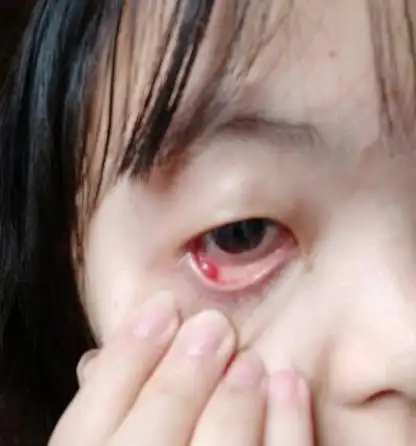 眼睛起个包是霰粒肿还是麦粒肿-霰粒肿交流网