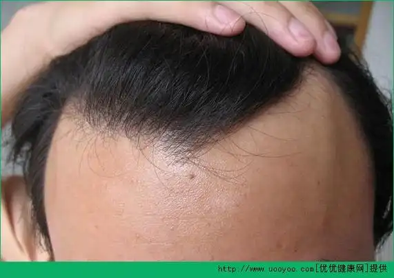 脱发的早期症状是什么如何正确辨别脱发多图