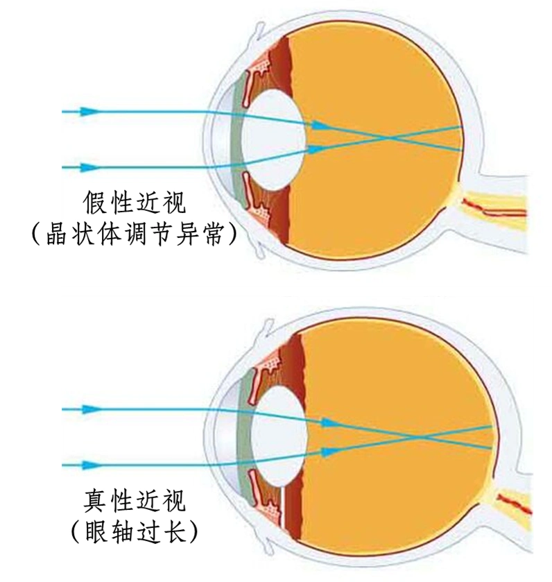 孩子天生都是"远视眼","远视储备"应该这样来珍惜
