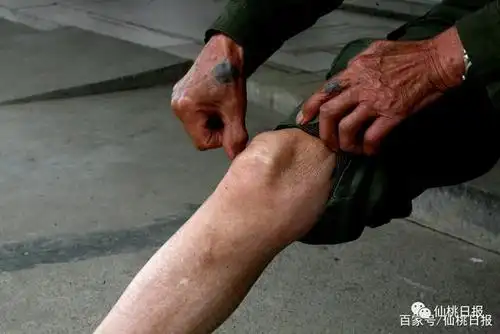 许治礼膝盖上被弹片擦伤后的疤痕