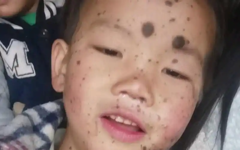 人家的衣服,因为家里面很贫穷,钱都留给他治病,孩子是先天性的兽皮痣