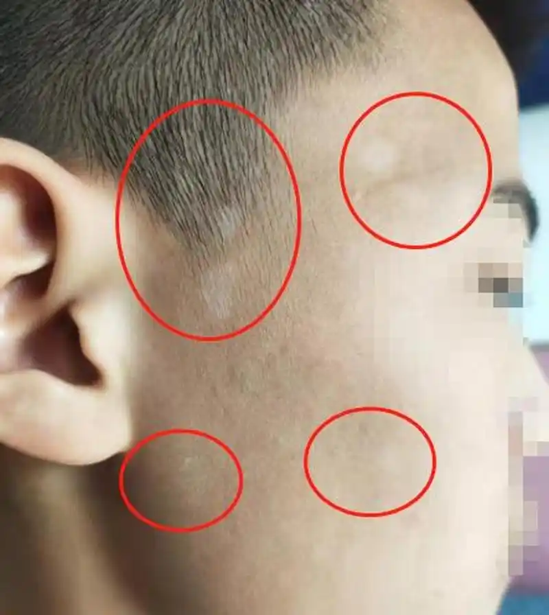 花斑癣,花斑疹既往又称花斑,俗称汗斑 是由马拉色菌累及皮肤角质层