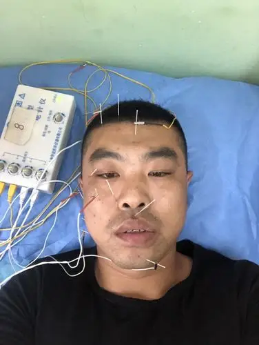 这个面瘫穴位针灸的对吗