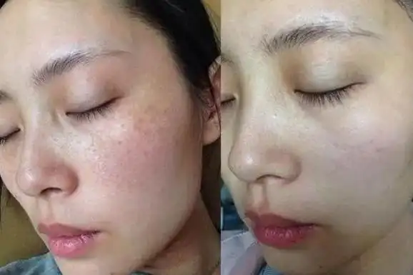 如何美白淡斑?超皮秒祛斑有何优势?