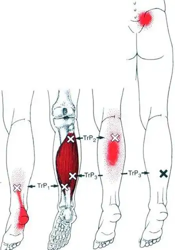 激痛点疗法——比目鱼肌