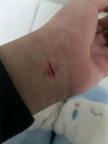 初二学生因父亲去世为何采用自残去解压