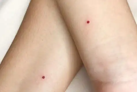 朱砂痣是什么样子,朱砂痣是什么意思_果仁网