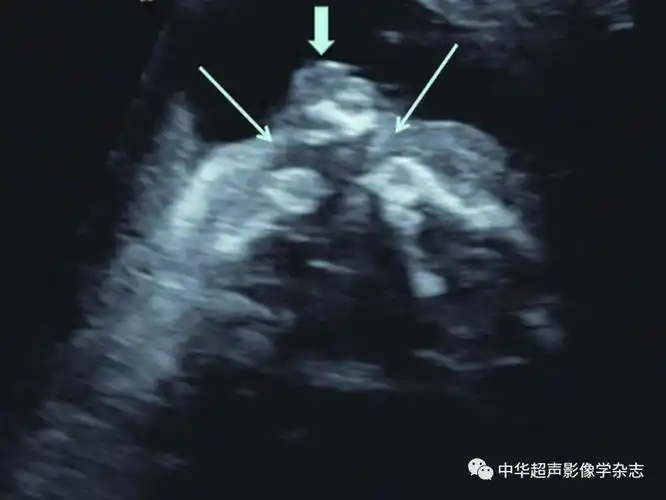(箭头所示);b:正常胎儿面部正中矢状面下唇裂非常罕见且超声诊断困难